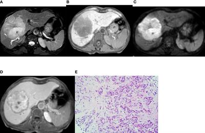 Corrigendum: DWI Combined With Hepatobiliary Phase Enhanced Imaging Can Better Differentiate Cholangiocarcinoma From Atypical Liver Abscesses